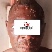 Kasai : Trois cas suspects de Mpox signales a Luebo, dont un deces a Bena Kashiya